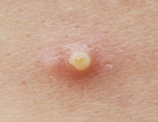 Çıban Tedavisi ve Önleme Yöntemleri